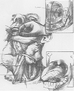 Diagrama. 2A Diagrama que muestra la resección del tumor, del tejido blando del piso de la boca y disección de cuello. En 2B y 2C se destacan los límites quirúrgicos.