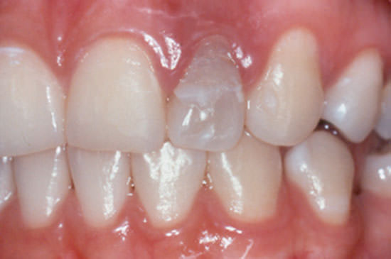 Fig. 1 Incisivo lateral superior izquierdo con alteración del color, inflamación gingival y mobilidad.