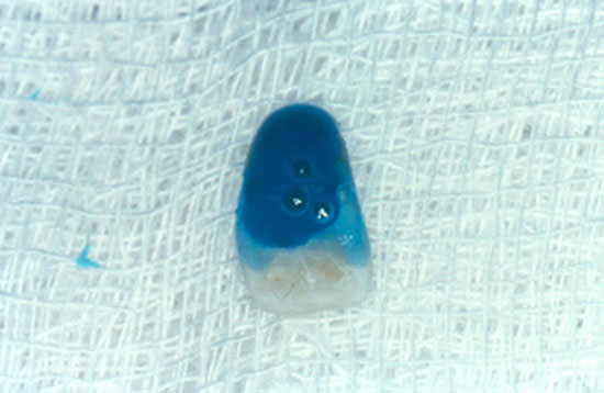 Fig. 13 Condicionamiento ácido del fragmento.