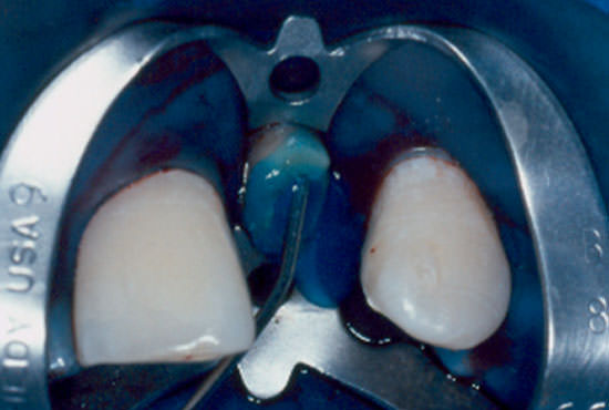 Fig. 15 Condicionamiento ácido del remanente dental.