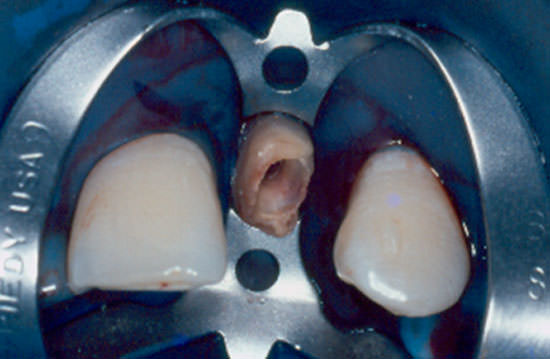 Fig. 16 Aplicación del sistema adhesivo en el remanente dental.