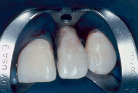 Fig. 17 Fijación del fragmento coronário.