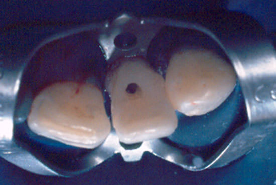 Fig. 18 Abertura intracoronária para viabilizar el tratamiento endodóntico.