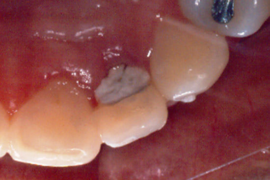 Fig. 2 Restauración provisória compatible con la abertura coronária.