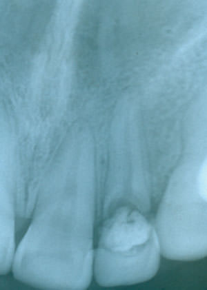 Fig. 3 Fractura dental en la región cervical (corona / raiz), con compromiso de la cámara pulpar.