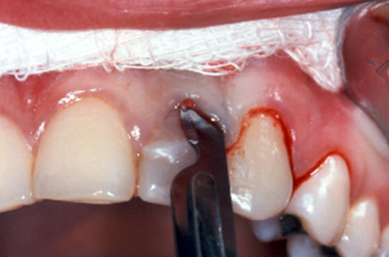 Fig. 4 Incisión intra-surcular.