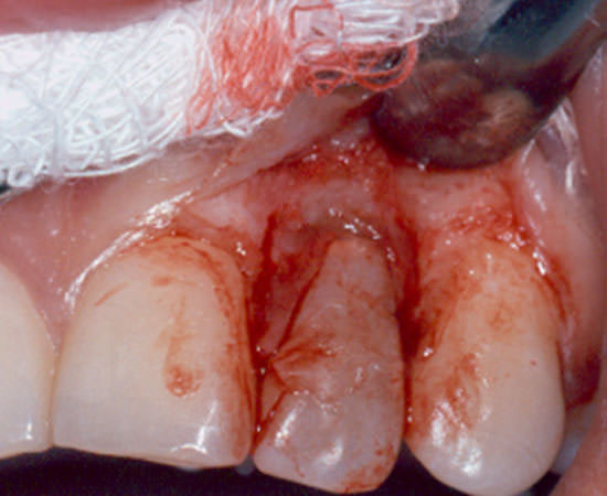 Fig. 5 Levantamiento del colgajo muco-perióstico.