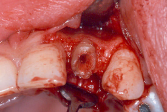 Fig. 6 Remoción del fragmento y visualización del límite de la fractura dental.