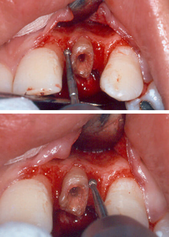 Fig. 7 y 8 Reconstitución de las distancias biológicas mediante osteotomía y osteoplastía.