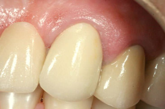 Cuadro 6 Prueba estética y funcional de la porcelana.